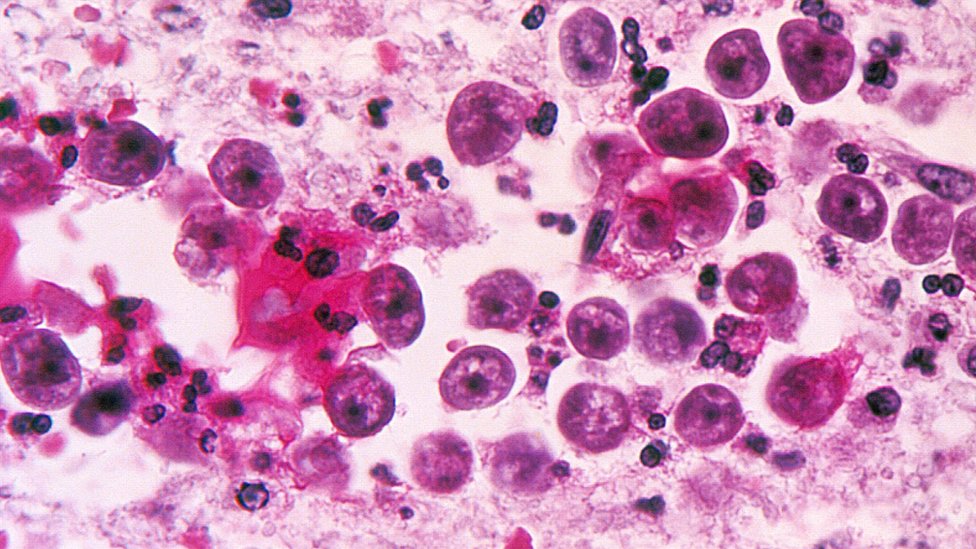 A microscopic image of a Naegleria fowleri amoeba infection