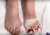 پاؤں کے ناخن اکھیڑ کر کس بیماری کا علاج کیا جاتا ہے؟