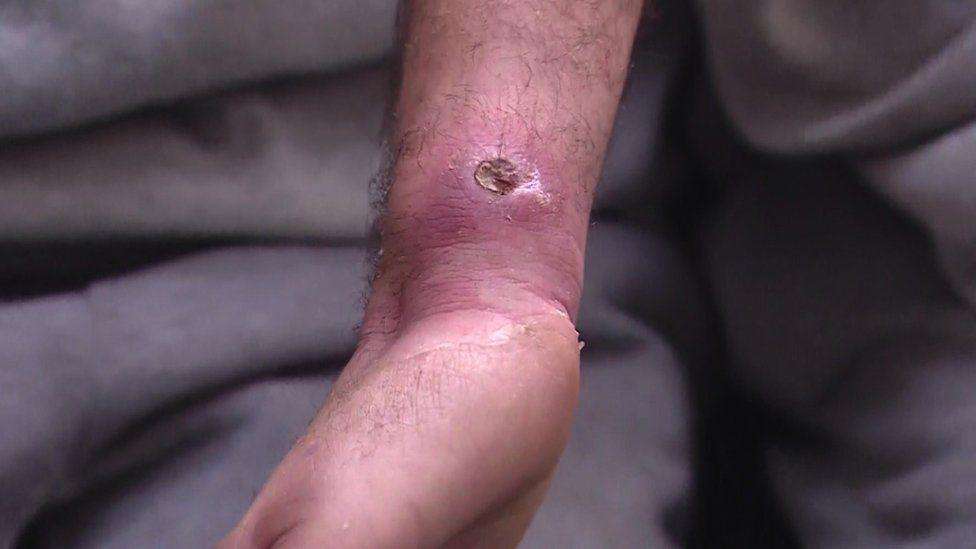 A deep wound and sore on one of the men's wrists