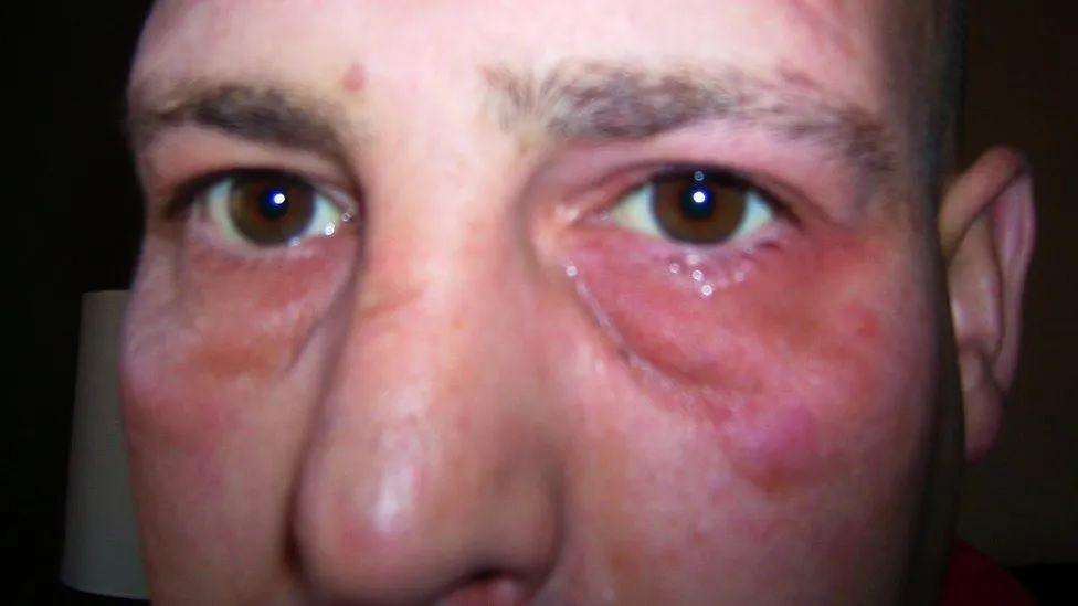 UK health ,headache, rare medical condition cluster headache